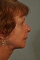 Chin Implant to correct profile view