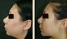 Chin Augmentation
