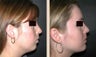 Chin Augmentation