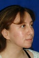 Rhinoplasty, chin implant, chin liposculpture, cheek fat pad removal