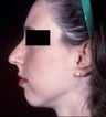 Rhinoplasty with Chin implant