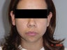 Chin Implants