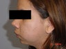 Chin Implants