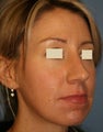 Rhinoplasty