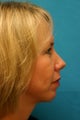 Chin Implant