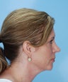 Revision Chin Implant