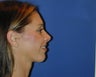 Chin Augmentation 