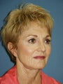 Chin augmentation with facial rejuvenation 