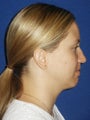 Chin implant Exchange for a more contemporary size medium chin implant and  Necklift with 15cc of VASER liposuction of the neck.