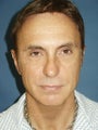  Chin augmentation, bilateral upper and lower blepharoplasty with canthopexy, and soft tissue fillers to the nasolabial folds 