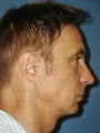  Chin augmentation, bilateral upper and lower blepharoplasty with canthopexy, and soft tissue fillers to the nasolabial folds 