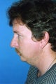 Chin Implant, Rhinoplasty