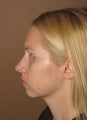 Chin enlargment and rhinoplasty combo