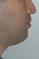 Chin augmentation, neck liposuction and neck muscle tightening.
