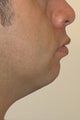 Chin augmentation, neck liposuction and neck muscle tightening.