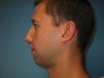 chin implant