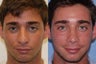 Chin Implant , Rhinoplasty