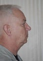 Chin Implant