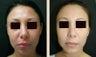 Chin Augmentation