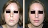 Chin Augmentation