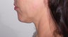 Chin Implant Procedure Combined with Facelift.