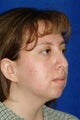 Rhinoplasty, chin implant, chin liposculpture, cheek fat pad removal