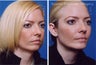Chin Implant