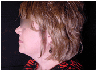 chin liposuction  with platysmal plication (mini necklift)