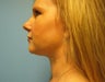 chin liposuction