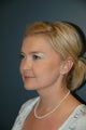 After Neck liposuction