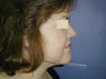 Chin Liposuction