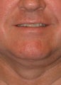 Liposuction
