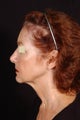 Chin Liposuction