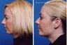 Chin Implant