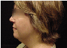 chin liposuction  with platysmal plication (mini necklift)