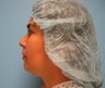 liposuction of chin
