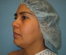 liposuction of chin