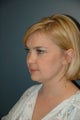 After Neck liposuction