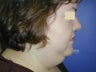 Chin Liposuction