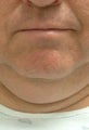 Liposuction