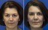 Chin Implantation with Rhinoplasty and upper lid blepharoplasty