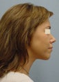 Chin Augments