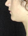 Chin Implant