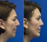 Chin Implantation with Rhinoplasty and upper lid blepharoplasty