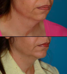Chin implant - chin augmentation and neck liposuction