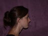 chin augmentation with chin implant
