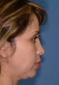 Chin Implant and Liposuction