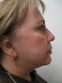 Chin Implant