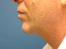 Chin Implant & Liposuction