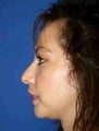 Chin Implants
